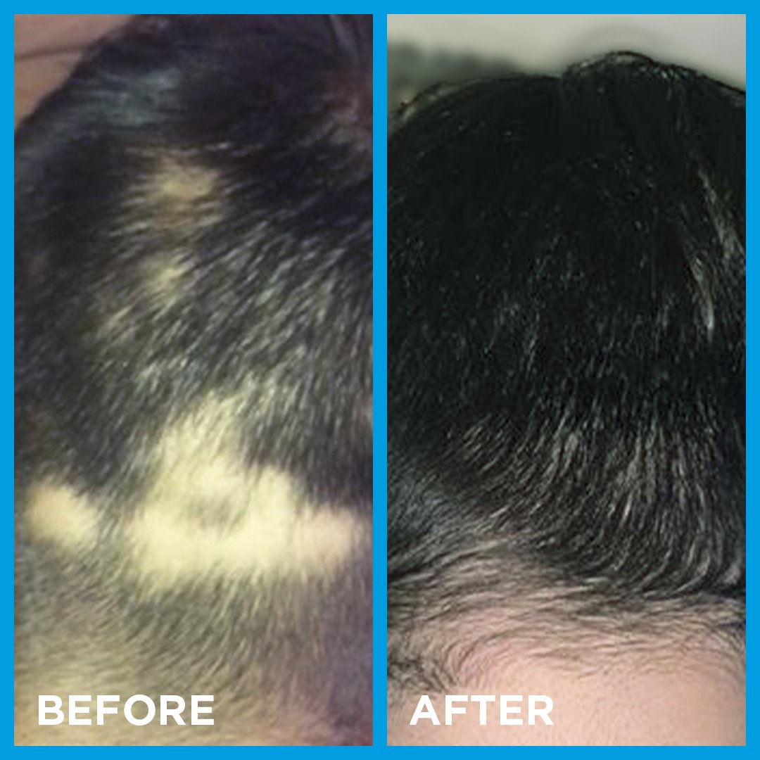 Alopecia areata before and after pictures Nourkrin Man