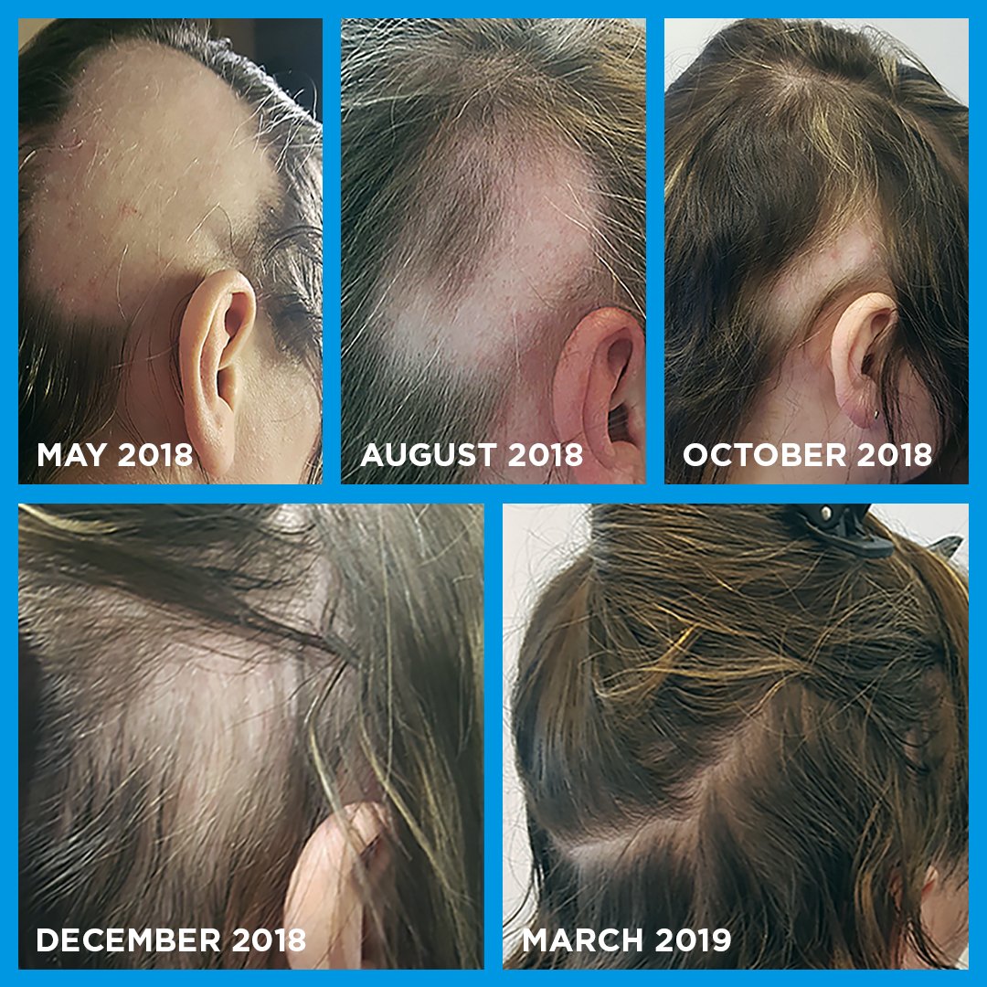 Alopecia areata before and after recovery pictures following Nourkrin Woman